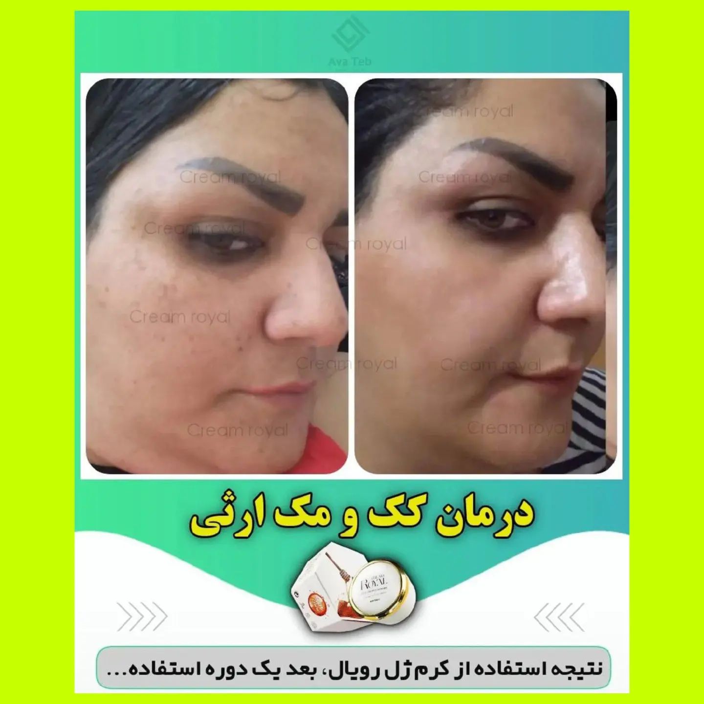 کرم ژل رویال ضد لک وروشن کننده قوی