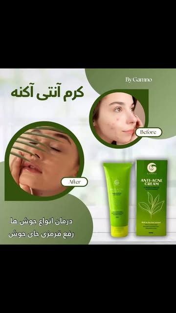 کرم آنتی آکنه ضدجوش تخصصی