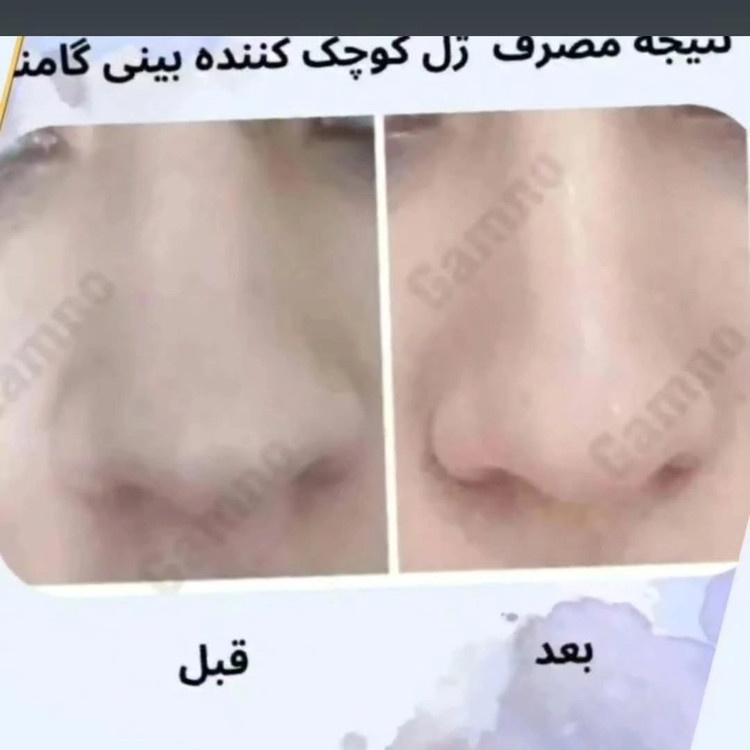 ژل کوچک کننده بینی گامنو مخصوص بینی های گوشتی