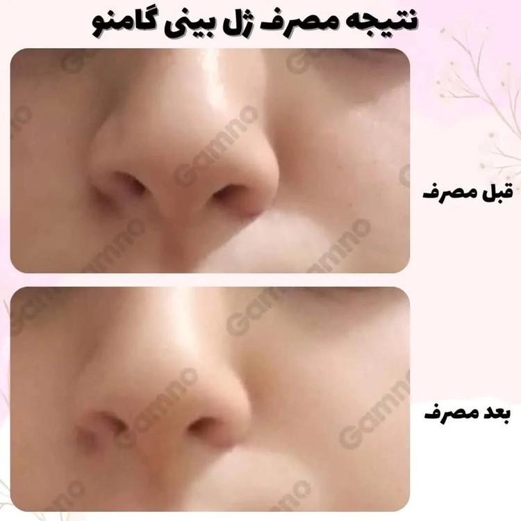 ژل کوچک کننده بینی گامنو مخصوص بینی های گوشتی