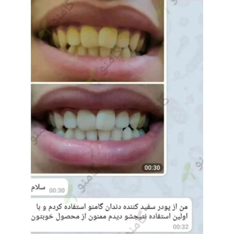 سفید کننده دندان گامنو