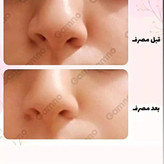 کوچک کننده بینی