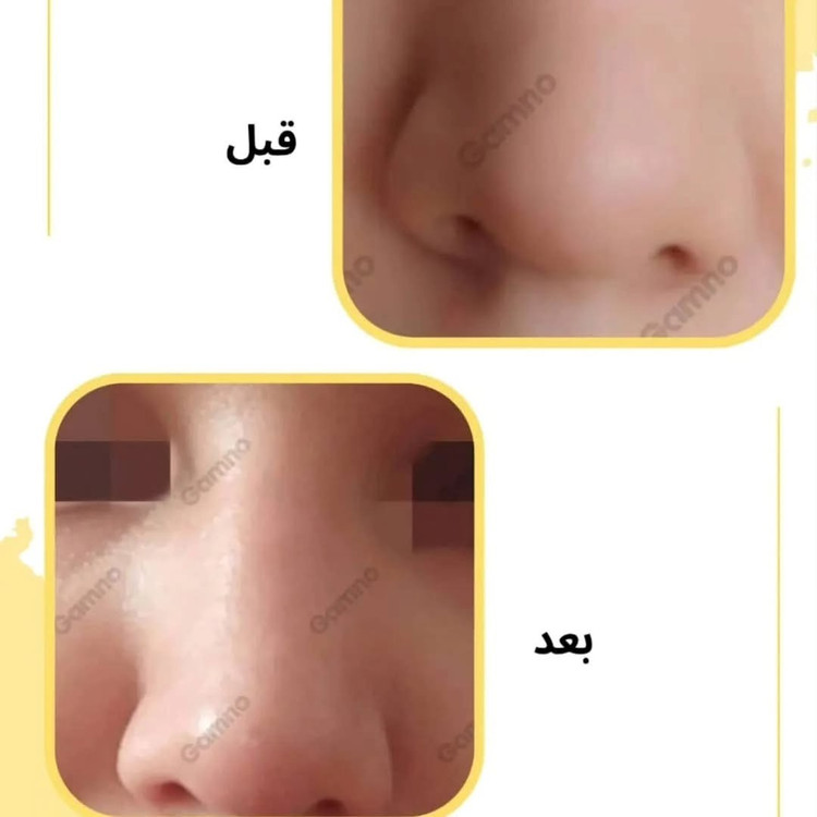 کوچک کننده بینی مخصوص بینی های گوشتی(جواب دهی عالی)