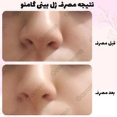 کوچک کننده بینی مخصوص بینی های گوشتی(جواب دهی عالی)