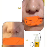 کوچک کننده بینی مخصوص بینی های گوشتی(جواب دهی عالی)