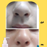کوچک کننده بینی مخصوص بینی های گوشتی(جواب دهی عالی)