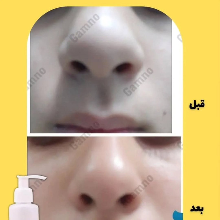 کوچک کننده بینی مخصوص بینی های گوشتی(جواب دهی عالی)